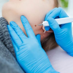 Mole and Wart Removal
