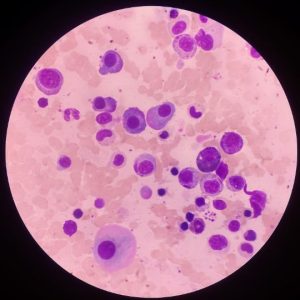 Multiple Myeloma